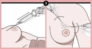 Fat Grafting Breast Reconstruction