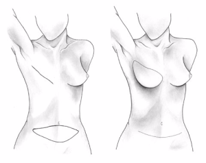 Types of Breast Reconstruction: DIEP Flap