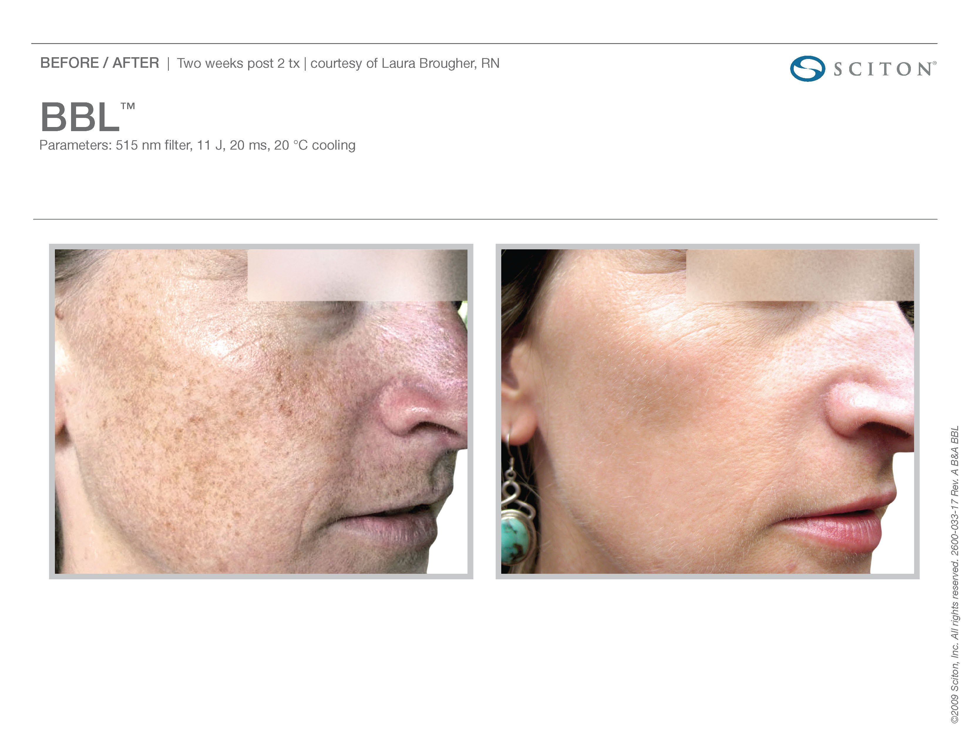 IPL Laser for Skin Treatment Laser Treatment Austin