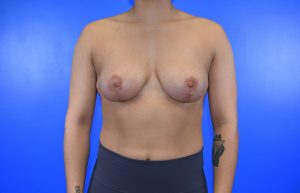 Patient 15 after breast reduction