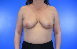 Breast Augmentation_implant before