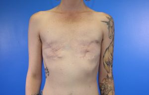 Implant Removal after