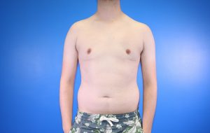 Gynecomastia after