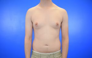 Gynecomastia before