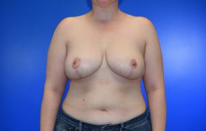 Breast Reduction after