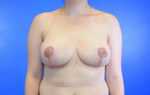 Breast Reduction after