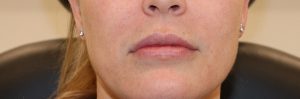 Juvederm Lip After