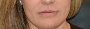 Juvederm Fill Lip before