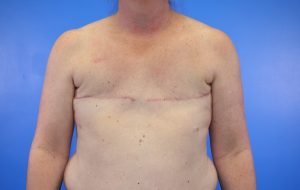 Reconstruction Implant Removal after