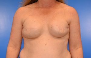 Reconstruction Implant removal before