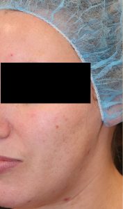 Microneedling Case 1 Before