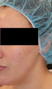 Microneedling Case 1 After