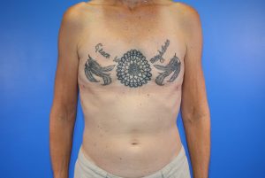 Implant Removal after