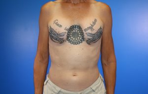 Implant Removal before