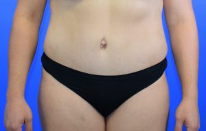 Abdominoplasty 11 after