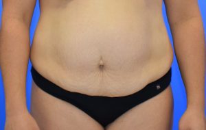 Abdominoplasty 11 before