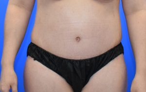 Abdominoplasty 17 after