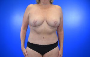 Mastopexy Abdominoplasty Case 21 after