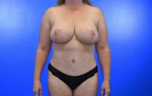 Breast Reduction Abdominoplasty after Case 24