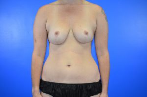 DIEP Flap Reconstruction Photo 3