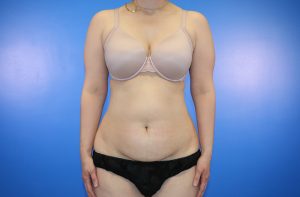 Tummy Tuck/Abdominoplasty Photo 4