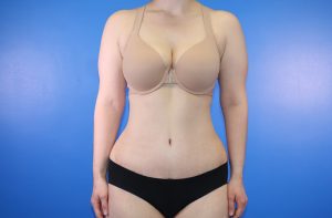 Tummy Tuck/Abdominoplasty