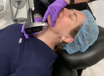 FotoFacial RF Microneedling