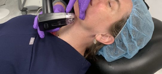 FotoFacial RF Microneedling