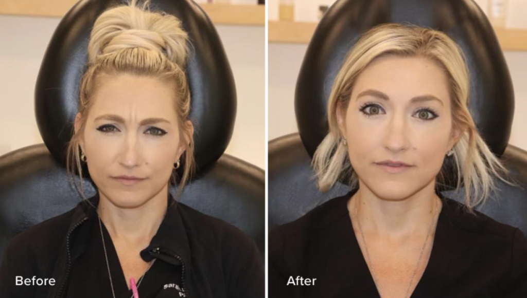 Botox Before and After